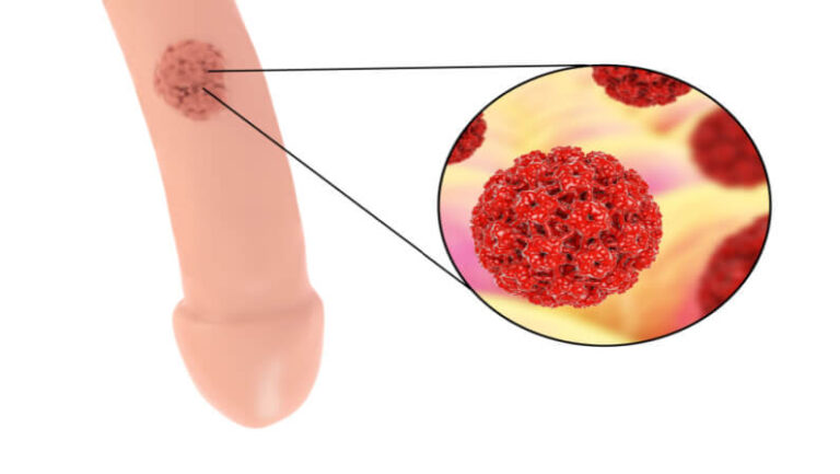 genital warts