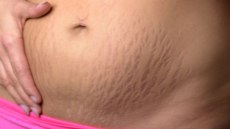 how to remove stretch marks fast