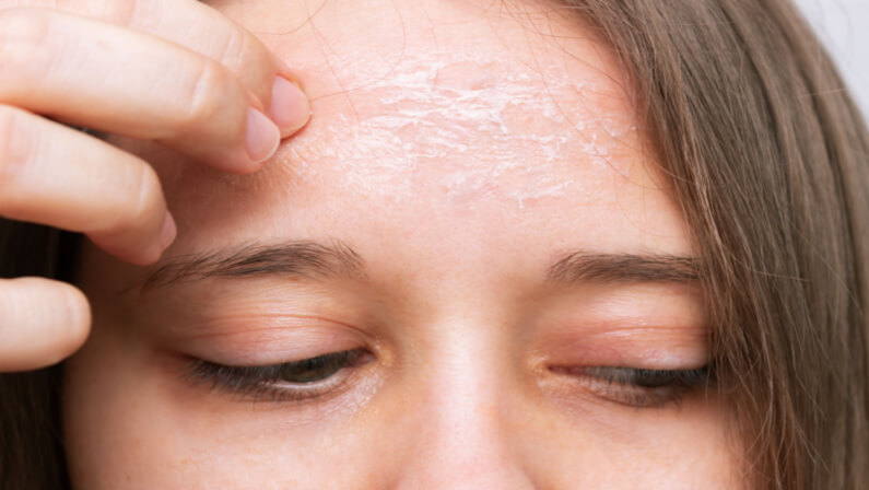 face flaking