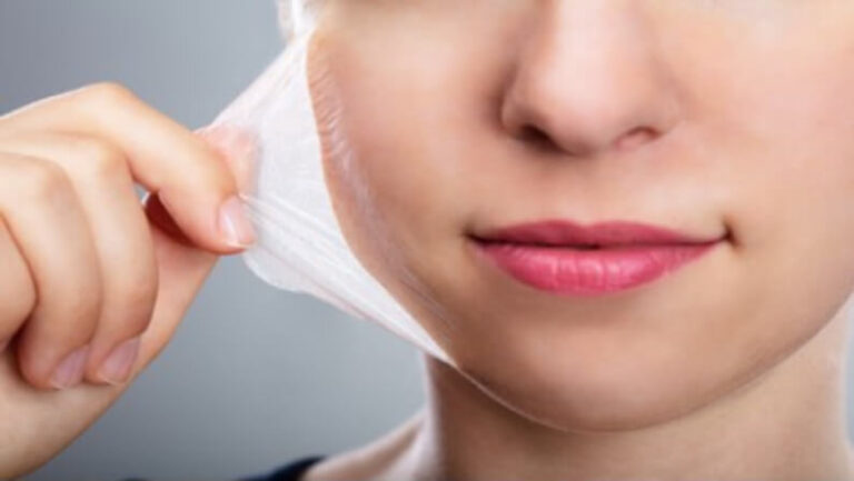 light chemical peel
