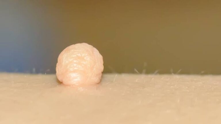 skin tag