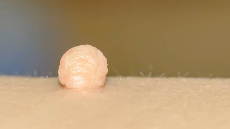skin tag