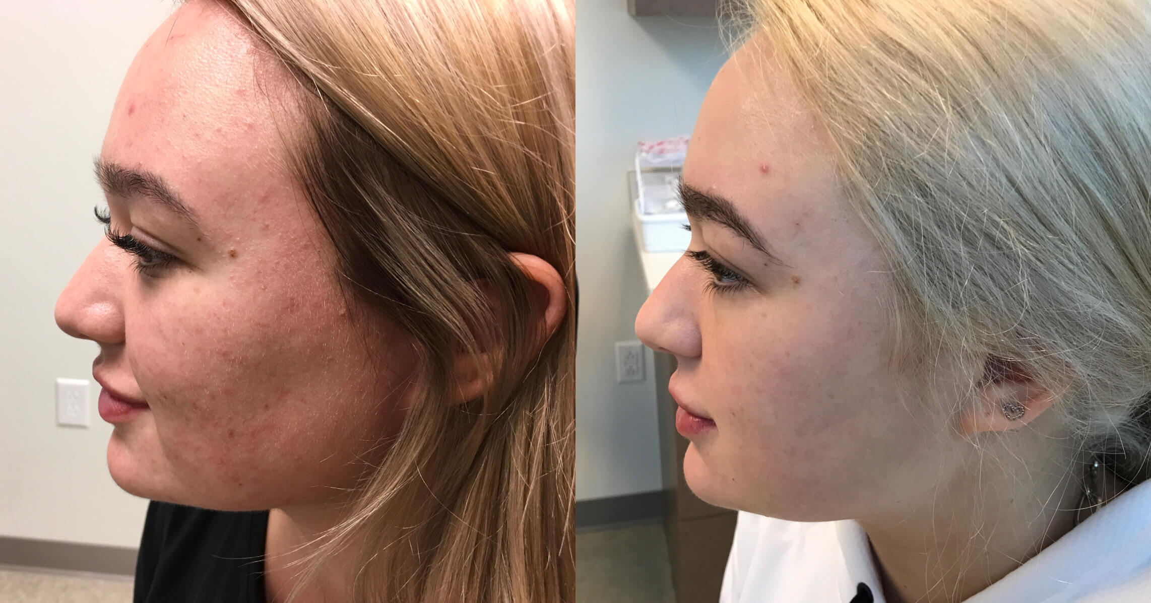 Before and after comparison of a young woman’s face showing improvement in skin texture and clarity. The left side displays skin with acne scars and blemishes, while the right side highlights a smoother complexion with reduced imperfections. Both profiles showcase her facial features, including her nose and chin, with visible changes in skin condition. The background is a clinical setting, indicating a skincare treatment or consultation. This image illustrates the effectiveness of skincare treatments in enhancing skin appearance and promoting confidence.