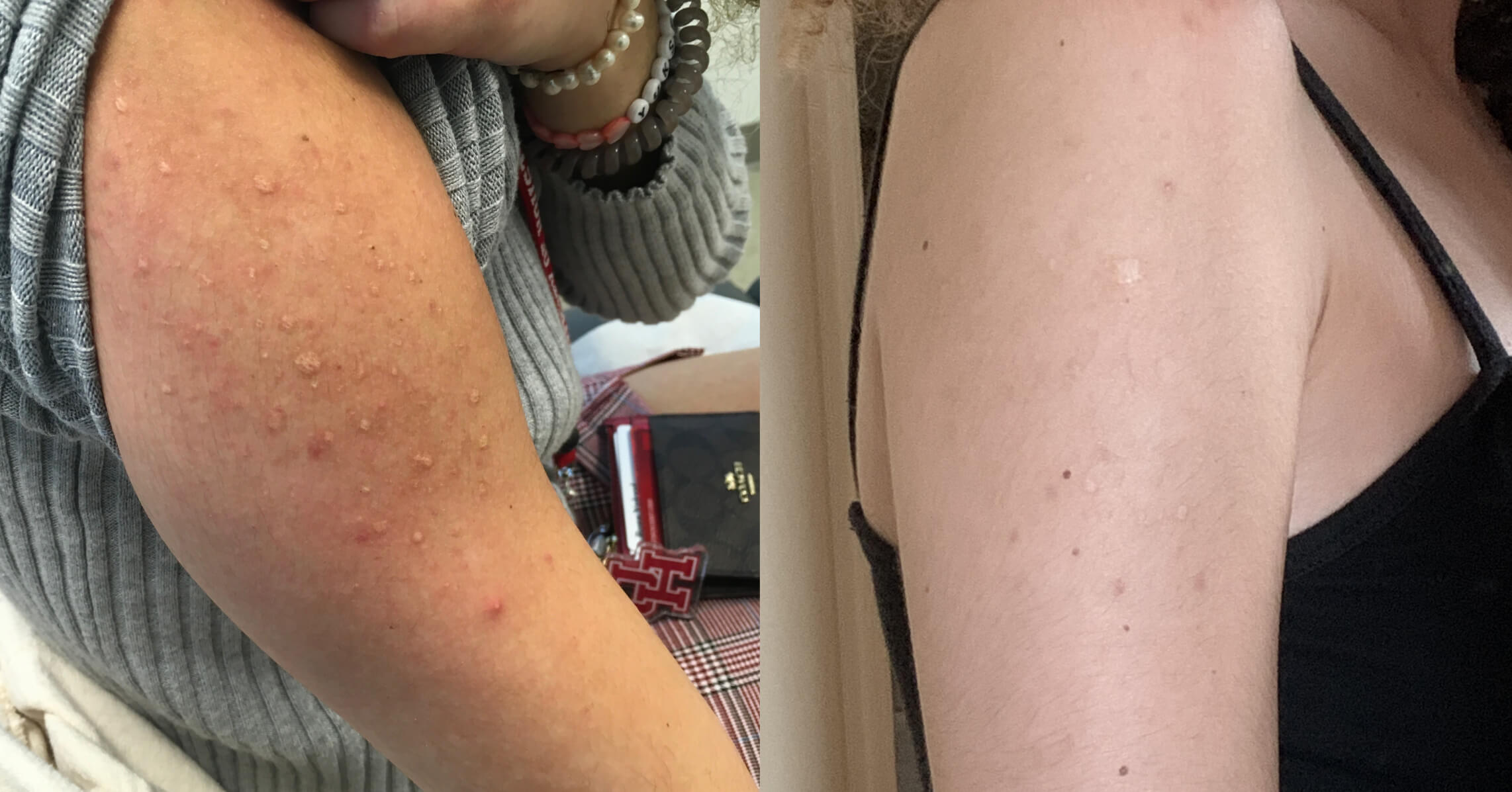 Image comparison showing two arms with different skin conditions. The left arm displays red, raised bumps and textured skin, indicating possible keratosis pilaris or another dermatological issue. The right arm has smoother skin with fewer visible imperfections, showcasing a contrast in skin texture and appearance. Both arms are partially covered and are positioned side by side to highlight the differences in skin conditions. This image serves as a visual reference for skin health discussions or educational purposes related to dermatology.