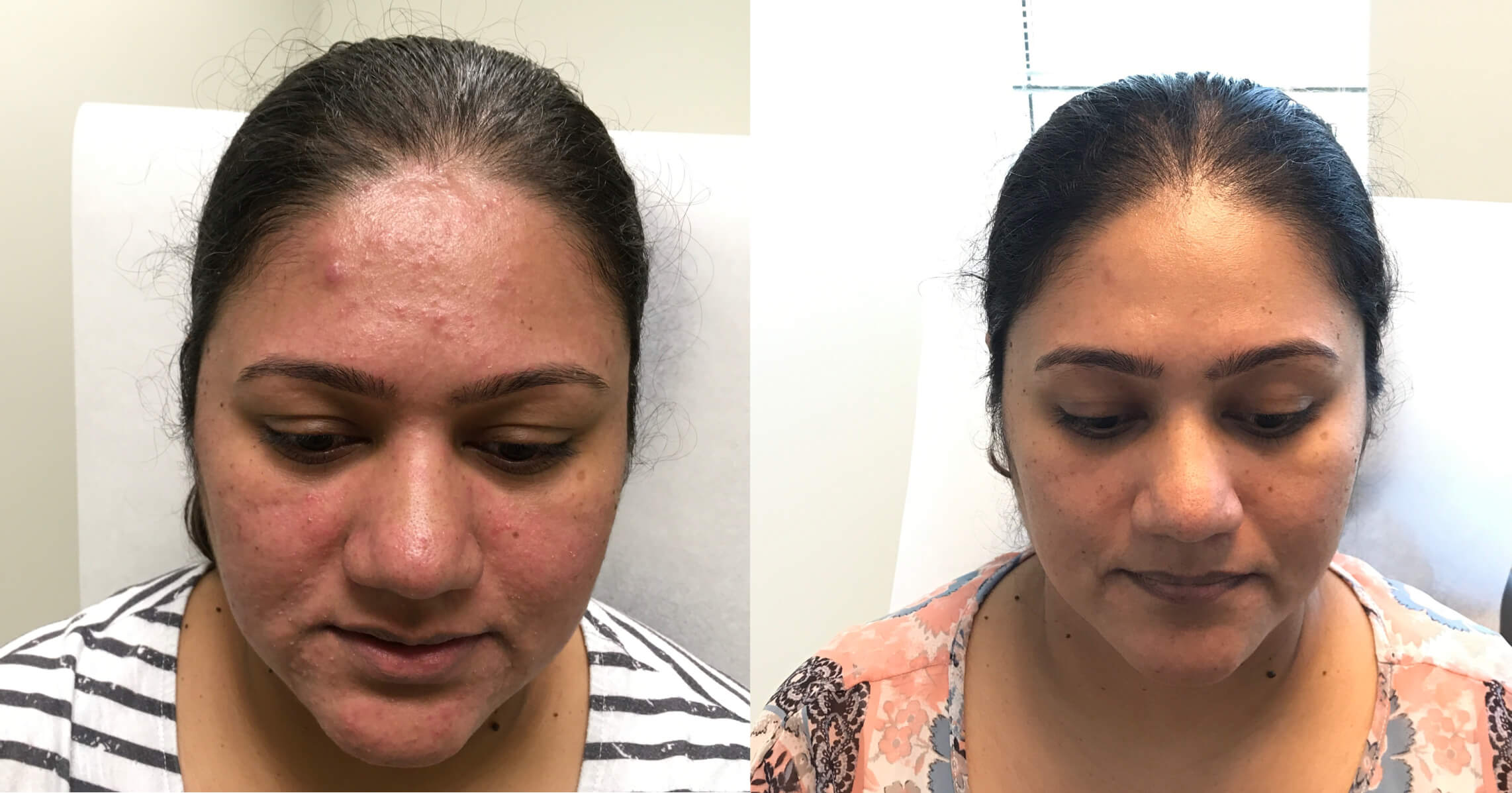 Before and after treatment images of a woman showing significant improvement in skin texture and clarity. The left side displays her face with noticeable acne and redness, while the right side shows a smoother complexion with reduced blemishes and an even skin tone. Both images highlight the effectiveness of dermatological treatments for acne and skin rejuvenation. The woman is seated in a clinical setting, emphasizing the professional environment where such treatments take place. This visual comparison serves as a testament to the transformative impact of skincare solutions.