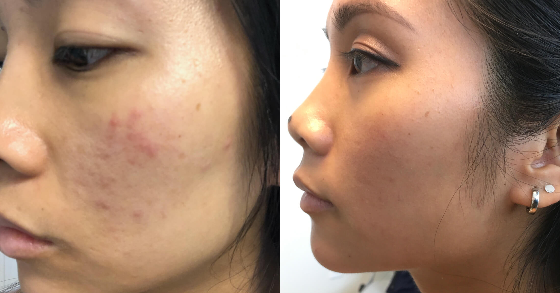 Side-by-side comparison of a person's face showing skin condition improvement. The left image displays acne scars and redness on the cheek, while the right image highlights clearer skin and a smoother complexion. This visual demonstrates the effectiveness of skincare treatments or dermatological procedures in reducing acne scars and enhancing skin texture. Ideal for educational content related to skincare, dermatology, or beauty treatments, emphasizing the transformation possible through proper care.