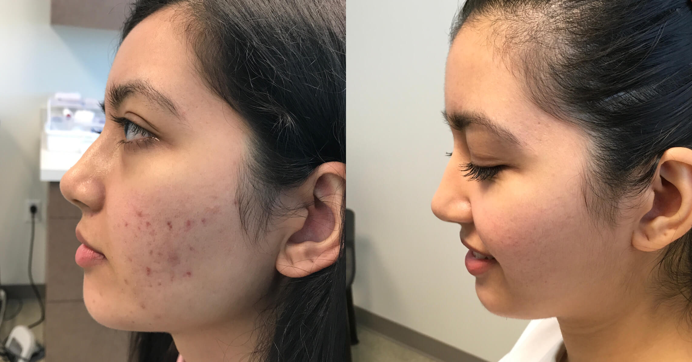 Before and after comparison of a young woman's face, showcasing the improvement in skin clarity and reduction of acne. The left side of the image displays visible acne scars and blemishes, while the right side presents smoother skin with a clearer complexion. The woman appears to be in a clinical setting, indicating a dermatological treatment or skincare consultation. This image highlights the effectiveness of acne treatment and the positive impact on self-esteem and skin health.