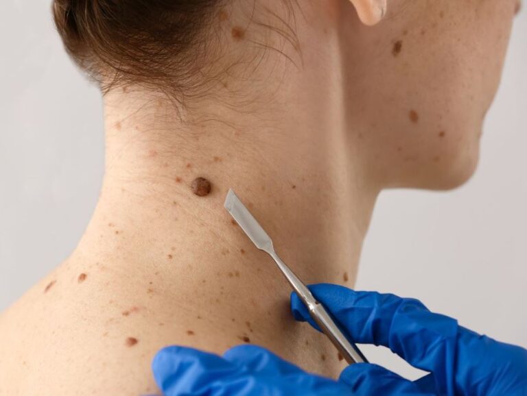 A healthcare professional in blue gloves performs a skin procedure on a patient&apos;s neck, focusing on a mole. The image shows the practitioner using a surgical tool to carefully examine or treat the skin lesions. This visual emphasizes the importance of skin health and regular check-ups for mole assessment, highlighting dermatological practices for early detection of potential skin issues.