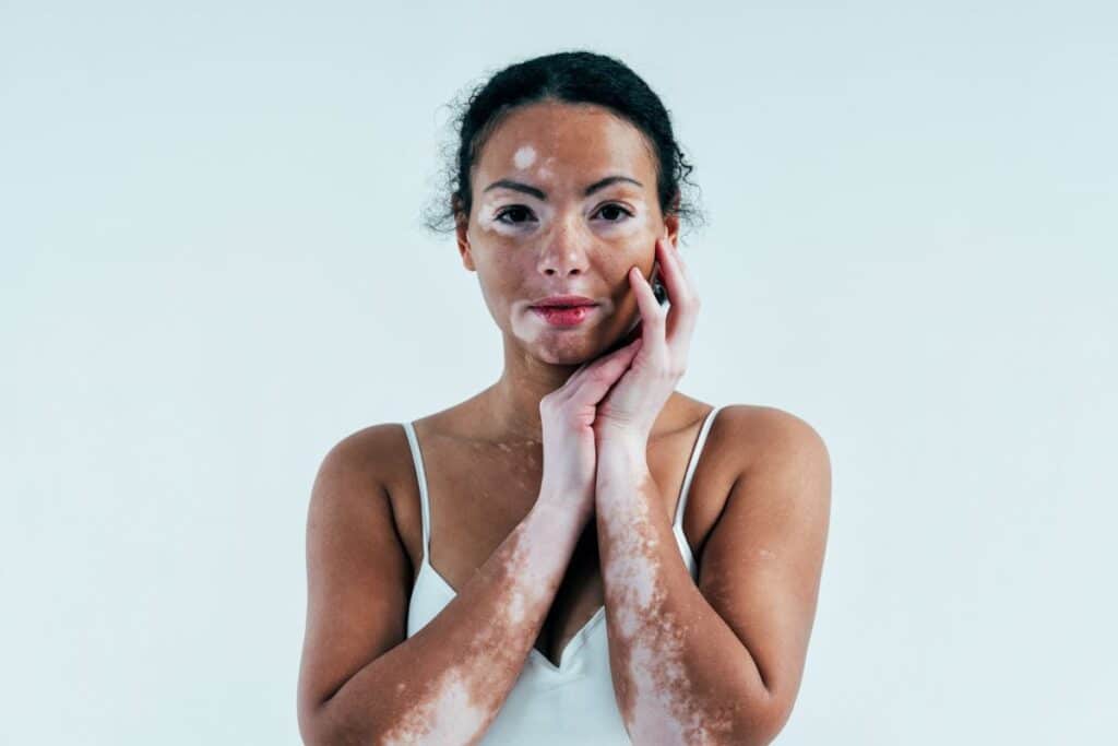 A woman with vitiligo poses thoughtfully against a plain white background, showcasing her unique skin pattern. She has dark, curly hair and is wearing a simple white tank top. Her hands are gently touching her face, emphasizing her features and the beauty of her skin condition. The image captures a moment of self-reflection and empowerment, promoting body positivity and awareness of skin diversity. This visual representation encourages conversations about inclusivity and self-acceptance in the context of beauty standards.