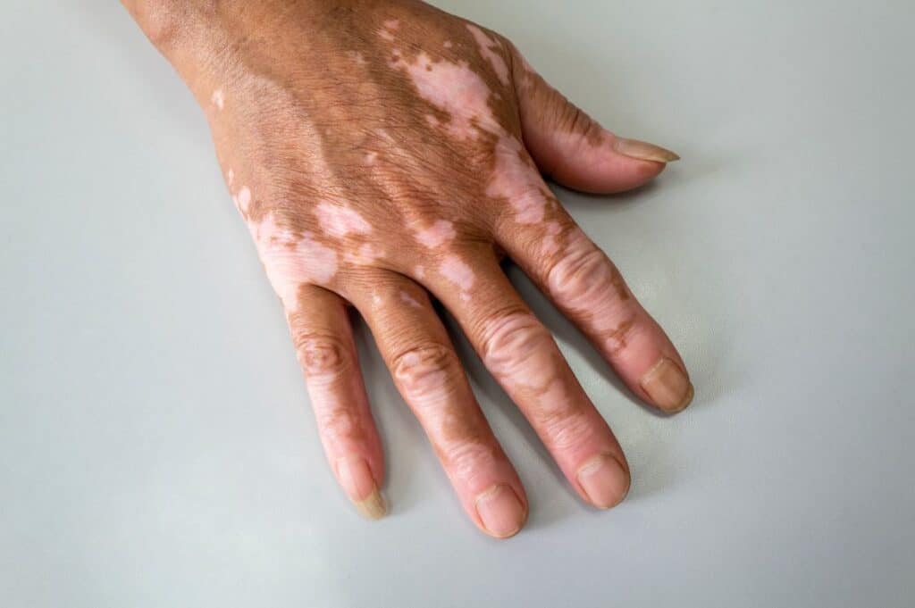 Close-up image of a human hand displaying vitiligo, characterized by patches of lighter skin tone contrasting with the surrounding skin. The hand is placed on a neutral background, highlighting the unique skin condition. This visual representation aims to raise awareness about vitiligo, its appearance, and its impact on individuals. The hand features neatly trimmed nails and a natural skin texture, emphasizing the normalcy and beauty of diverse skin conditions.