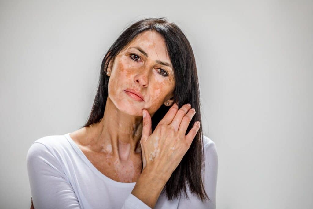 A woman with long dark hair and a white top gently touches her face, showcasing areas of skin discoloration. The background is neutral, emphasizing her facial features and skin condition. This image highlights the impact of skin conditions, promoting awareness and understanding of dermatological issues. The woman&apos;s expression is contemplative, inviting empathy and conversation about skin health and self-acceptance.
