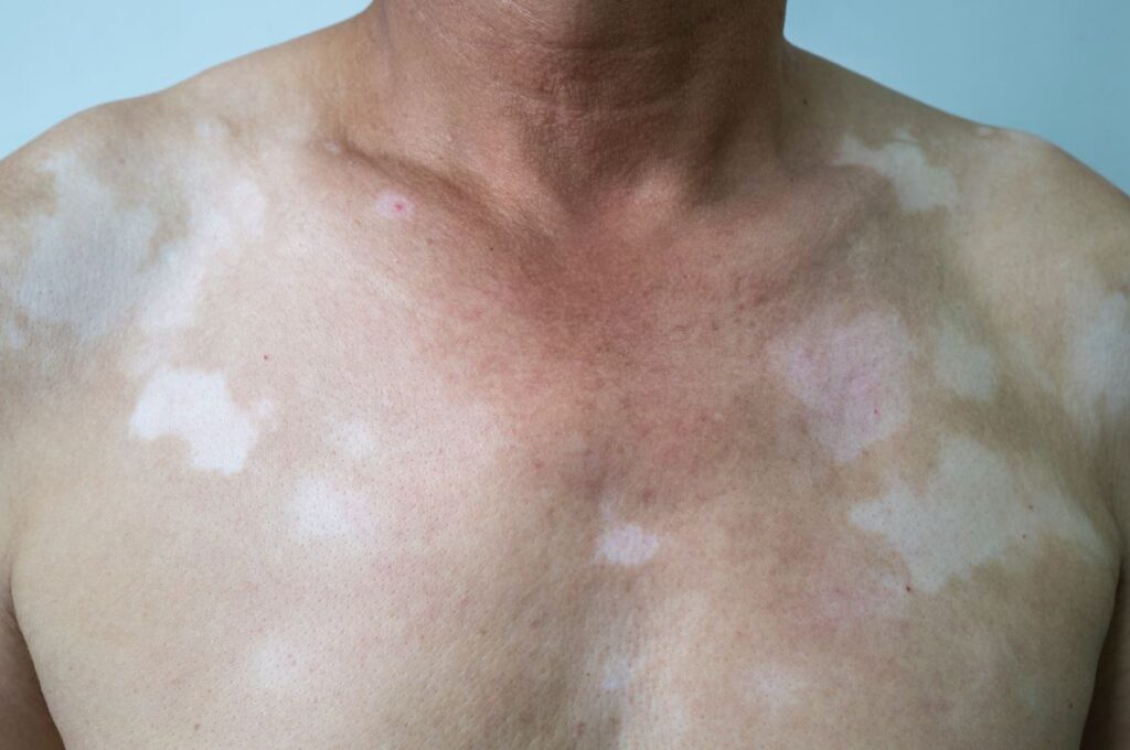 Close-up image of a person&apos;s chest showing patches of lighter skin, indicative of vitiligo, a skin condition characterized by the loss of pigment. The skin appears uneven with various shapes and sizes of depigmented areas. The background is a neutral color, emphasizing the skin condition. This image can be used to educate about vitiligo, its appearance, and its impact on individuals. It highlights the importance of understanding skin conditions for awareness and sensitivity.