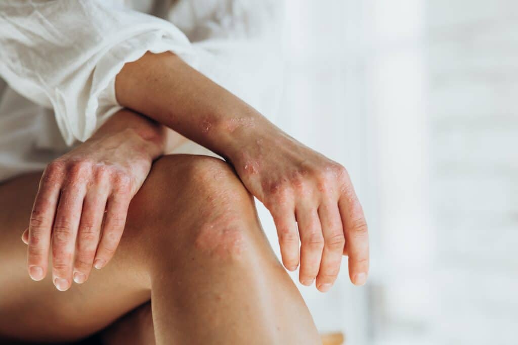 Woman with eczema in Houston, TX
