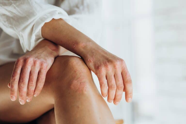 Woman with eczema in Houston, TX
