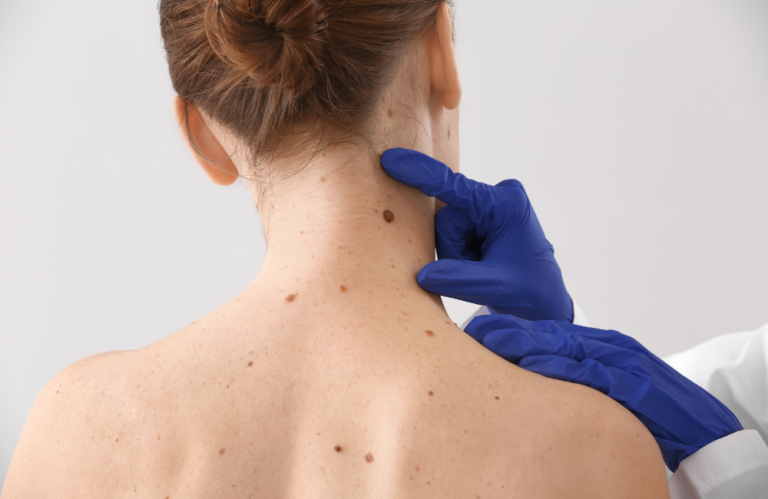 Doctor examines mole on patient&apos;s back with magnifying glass.