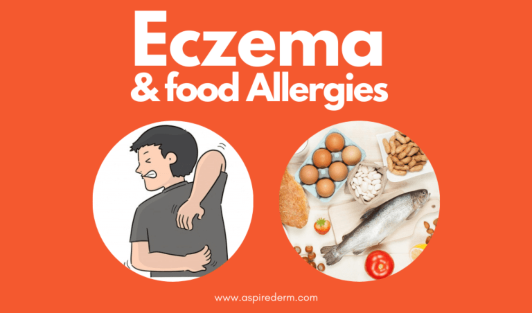 eczema and diet