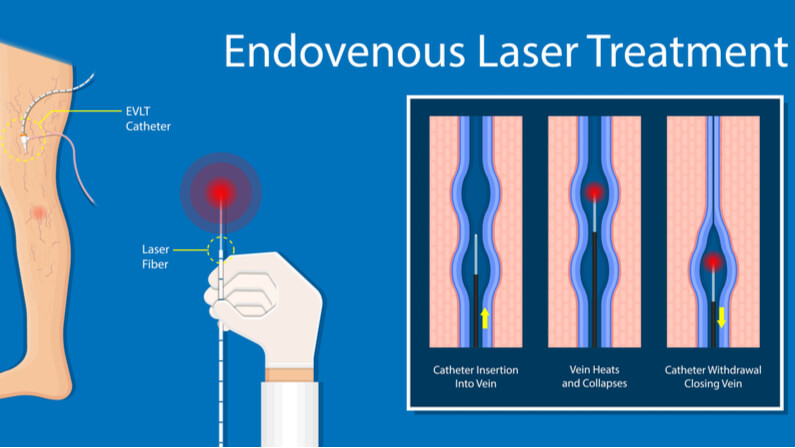 Endovenous laser ablation