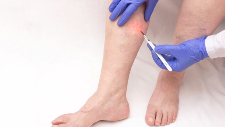 Remove Spider Veins Safely and Effectively