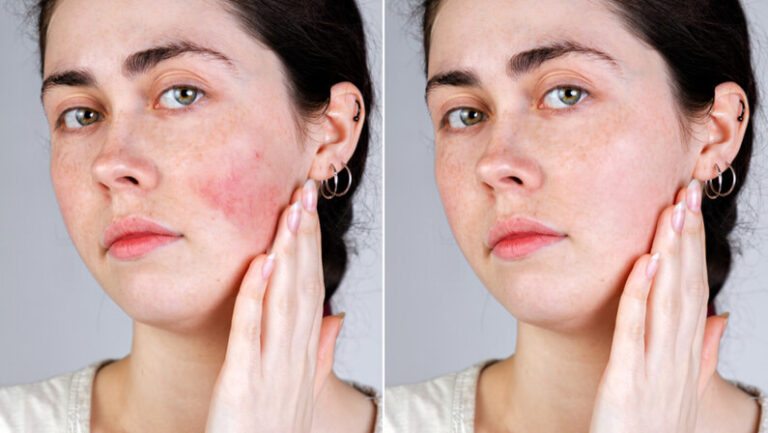 What’s The Best Treatment For Rosacea? - Team Dermatology