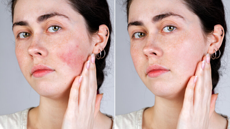 Rosacea Treatment before and after