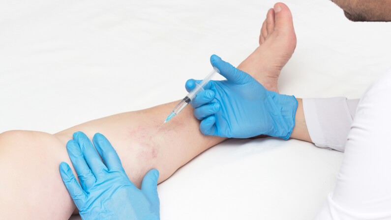 Sclerotherapy