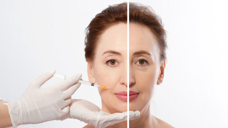 dermal fillers before and after