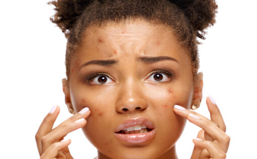 woman acne