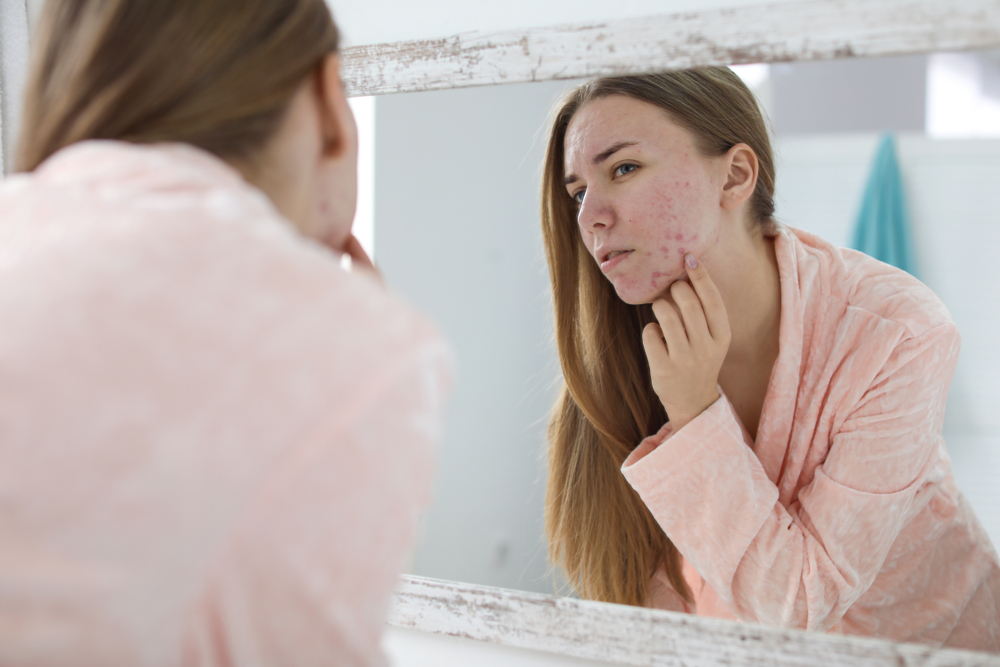 Oily skin means acne-prone skin - myth