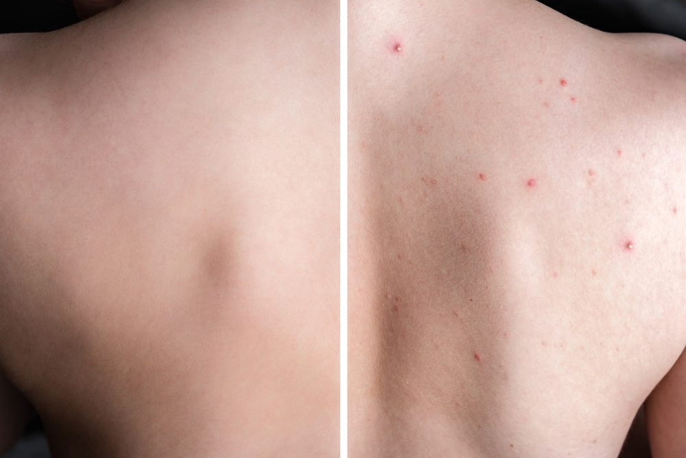 back acne before and after - treatment and prevention