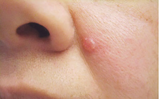 basal cell carcinoma