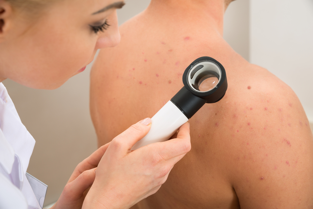 dermatologist checking back acne scars
