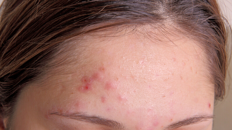 forehead pimples
