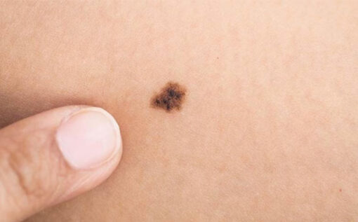 melanoma