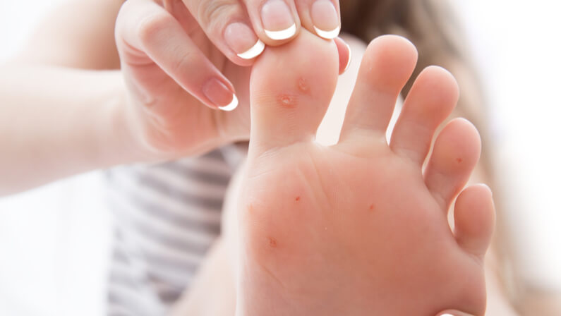 plantar warts