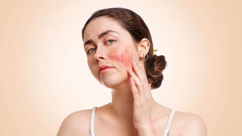 woman with rosacea