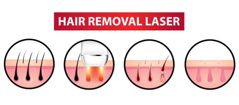 Safe Hair Removal Procedure