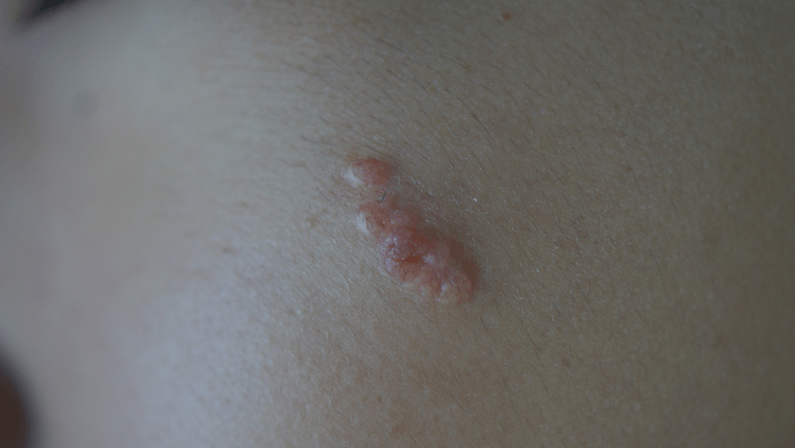 sebaceous glands bumps