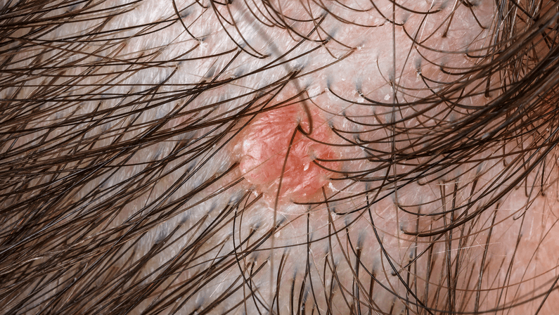 sebaceous glands bumps