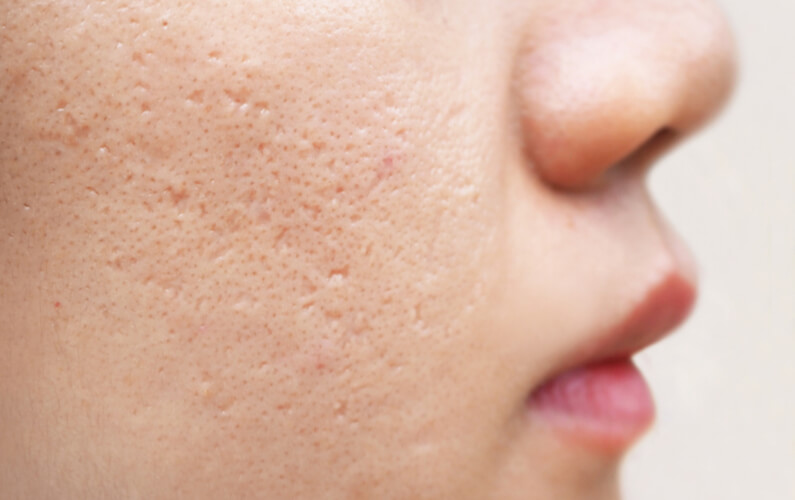 ice pick scars on woman face skin