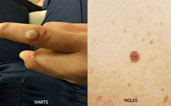 warts-vs-moles