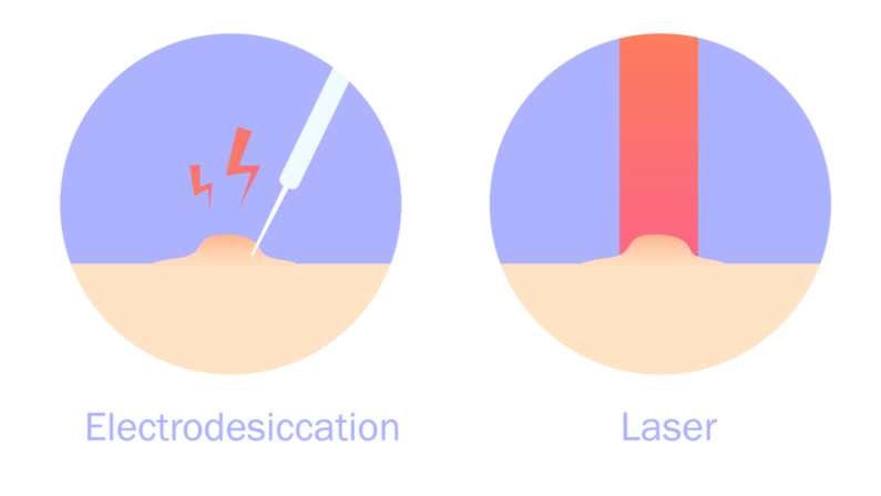 Electrodesiccation and laser procedure