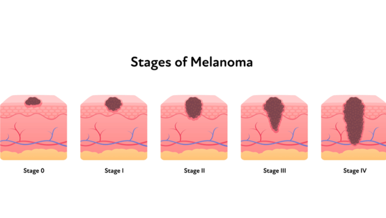 stages of Melanomas