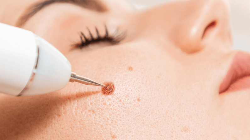 women to be operated her mole