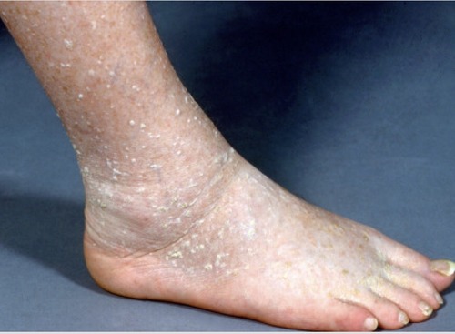 Stucco keratosis feet