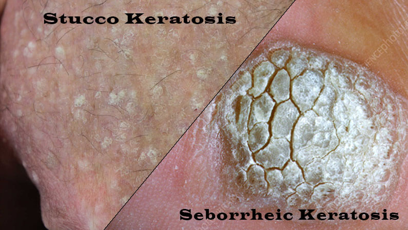 Stucco and Seborrheic Keratosis