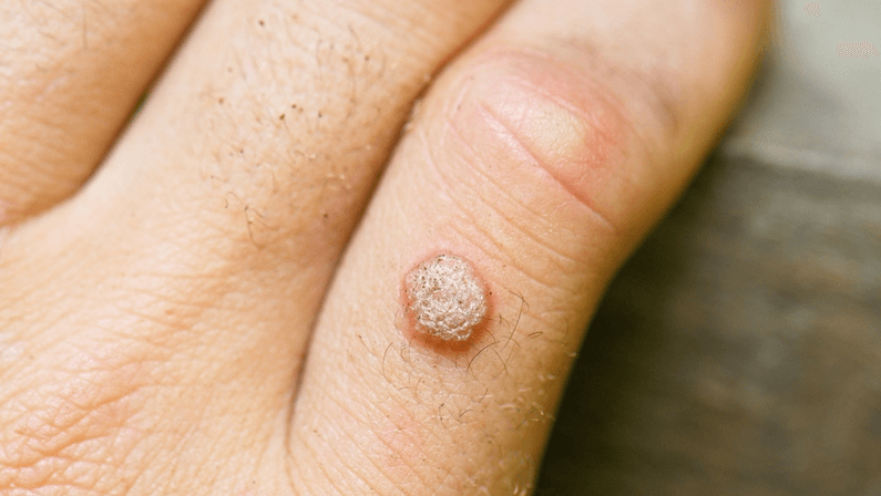 finger with a wart