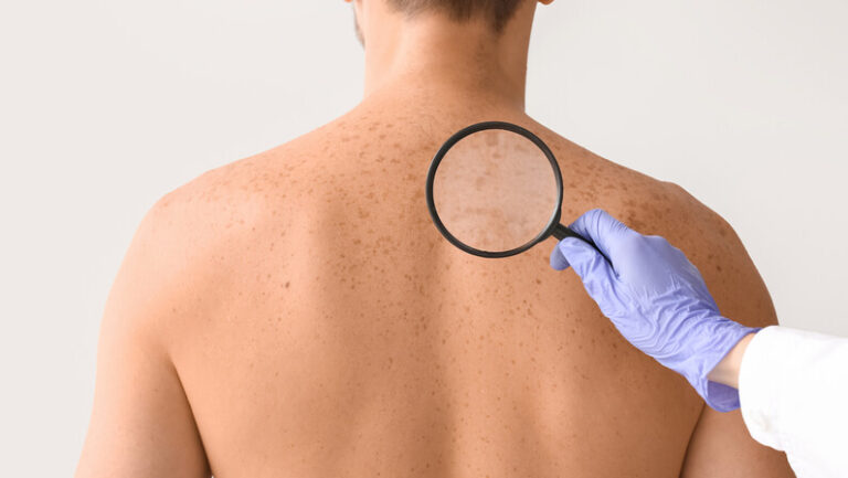 A patient diagnose of a possible skin cancer
