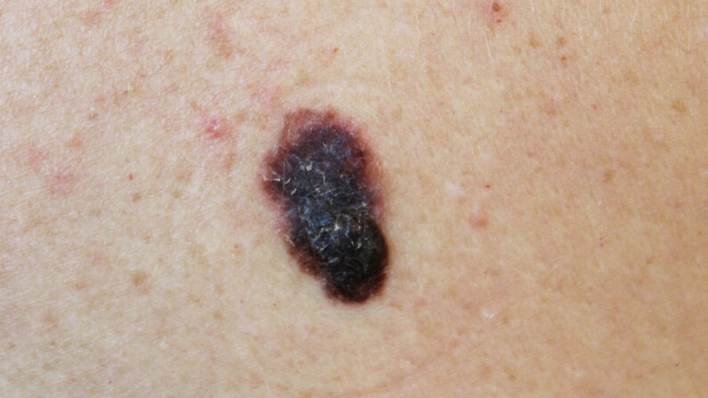a Melanoma on a close-up photo
