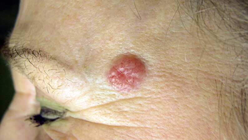a person with basal cell carcinoma