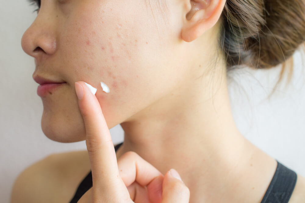 woman applying treatment lotion to acne